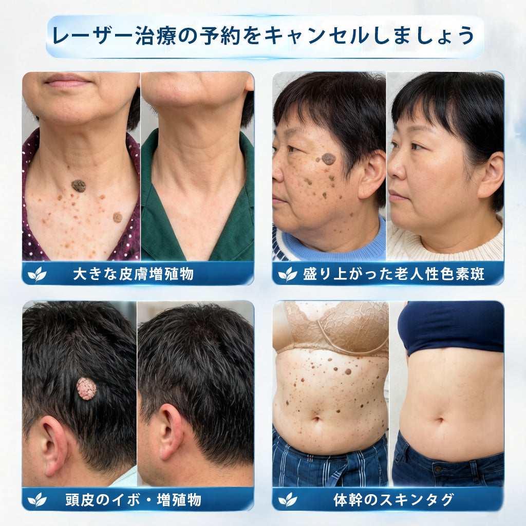 🎁ほくろ・イボ除去用 高機能ロールオン製品