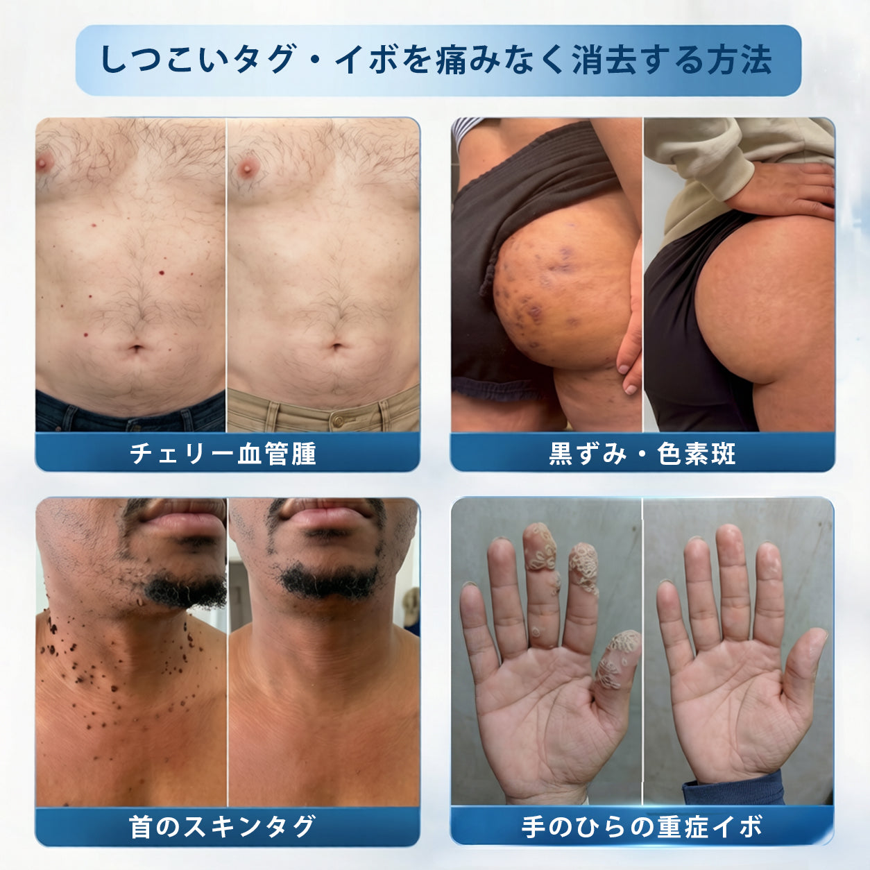 🎁ほくろ・イボ除去用 高機能ロールオン製品