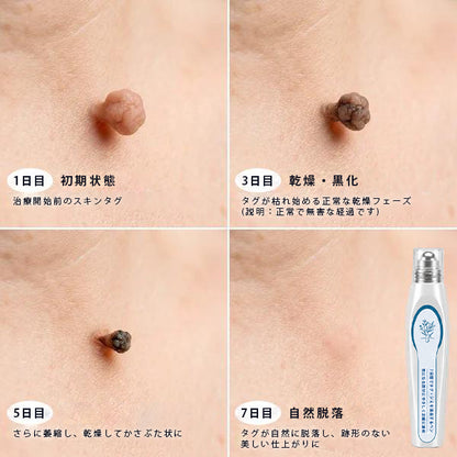 🎁ほくろ・イボ除去用 高機能ロールオン製品