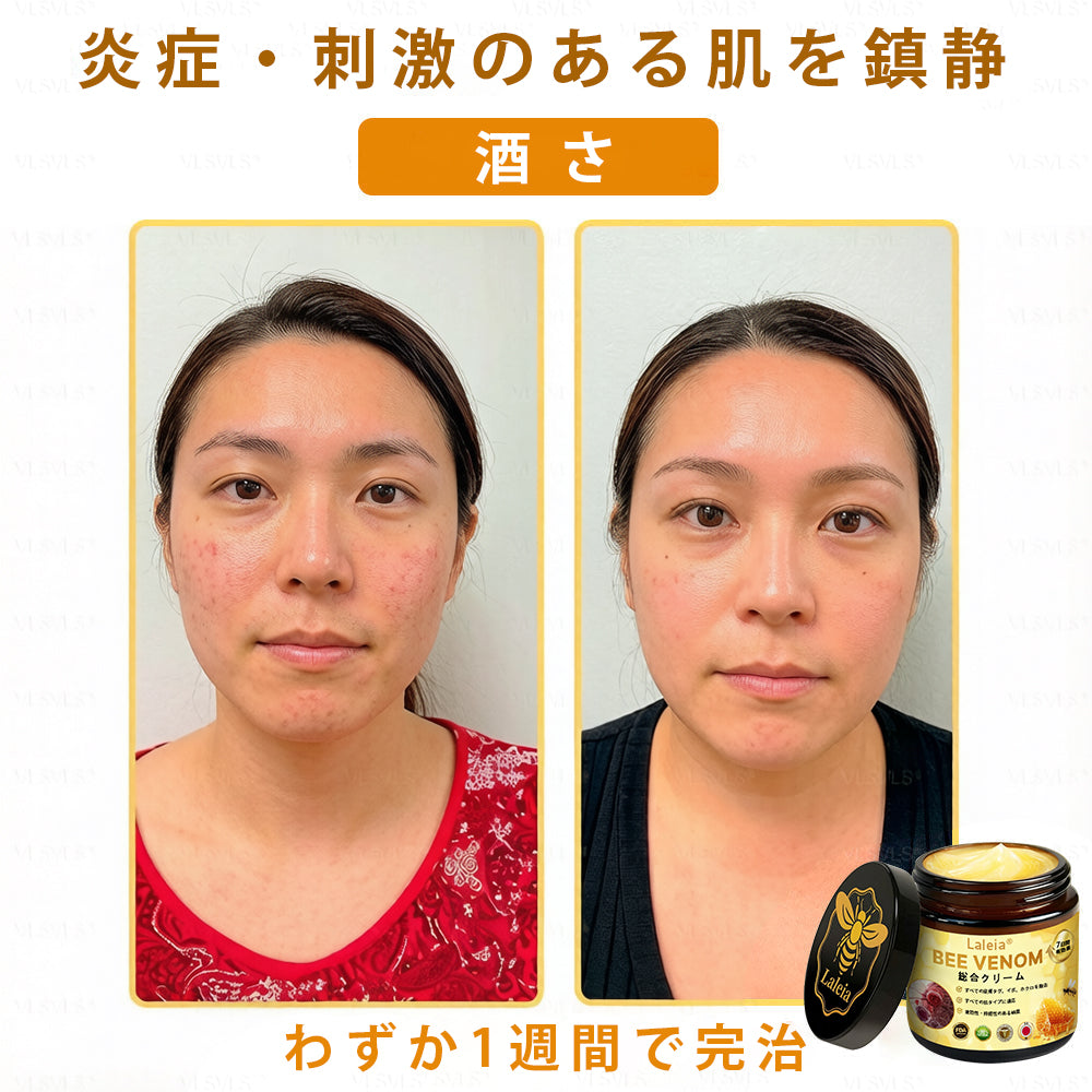 Laleia® ビーヴェノム総合クリーム 🇭🇲🇭🇲（年齢を問わずご使用いただけます）